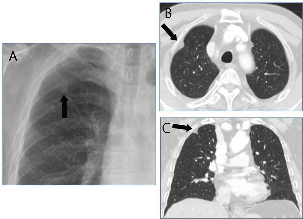Fig.: 6. Focal extrapleural fat in a 74-year-old man. A. Chest radiograph shows a focal increased opacity (arrow) with extrapleural sign in the right upper lobe. B, C.