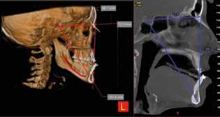 IMPLANT SITE ASSESSMENT Bone density estimate in a potential implant site, with Misch scale classification, to