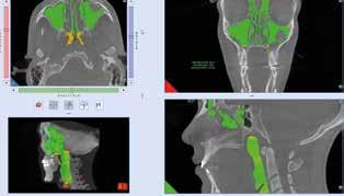 Designed to provide highly precise simulations of implant position, identify the mandibular canal, calculate bone