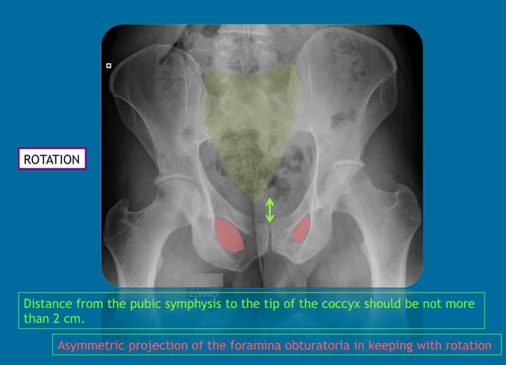 Fig. 3: Example of rotation of the pelvis : Ideally, the distance from pubic symphysis to the tip of the coccyx should be not more than 2 cm (no tilting) and the obturator foramina should be