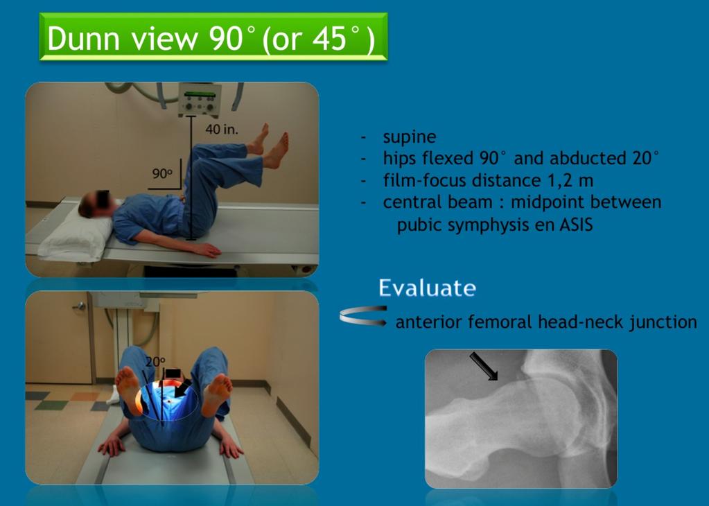 Fig. 5: Imaging technique and correct positioning for the Dunn view of the hip.