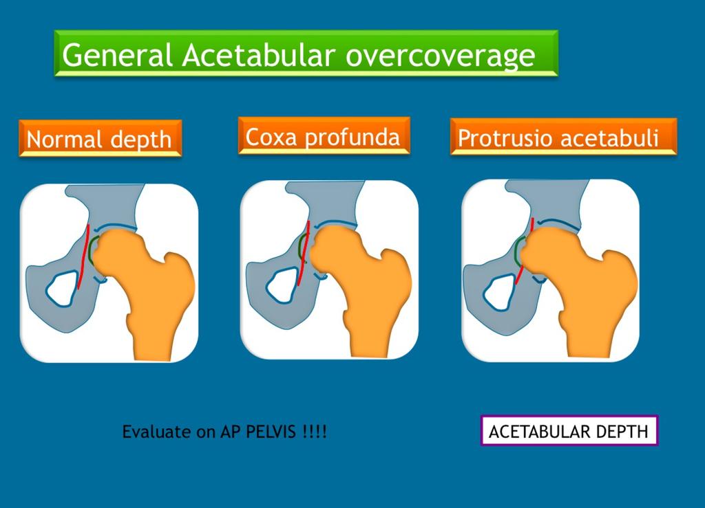 Fig. 6: Evaluation of general over coverage compared to normal coverage, to be evaluated on an AP pelvis and not on a hip view.
