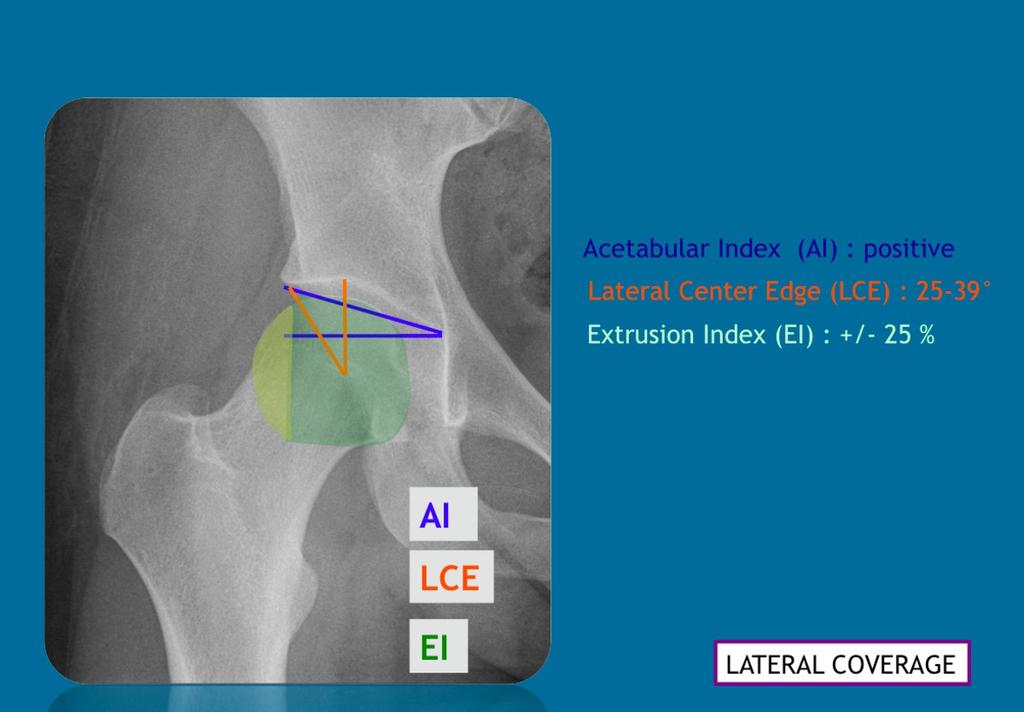 Fig. 8: Evaluation of lateral coverage on a normal hip : the
