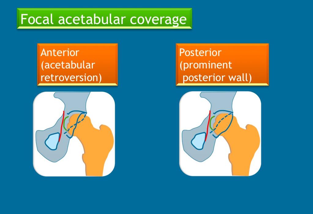 10: Overview of parameters and values for evaluating acetabular coverage in normal individuals, patients with dysplasia (undercoverage) and patients with