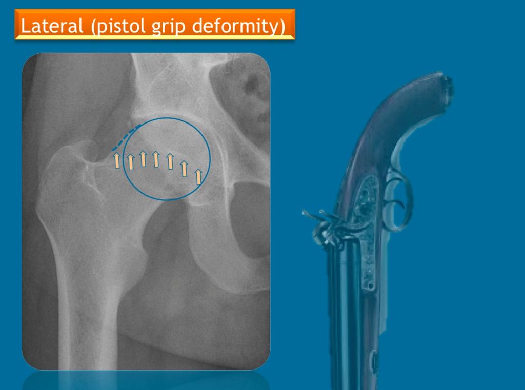 Fig. 15: Pistol grip deformity, characterized on AP pelvic radiographic (enlarged view), by flattening of the usual concave surface of the lateral aspect of the femoral head (dashed