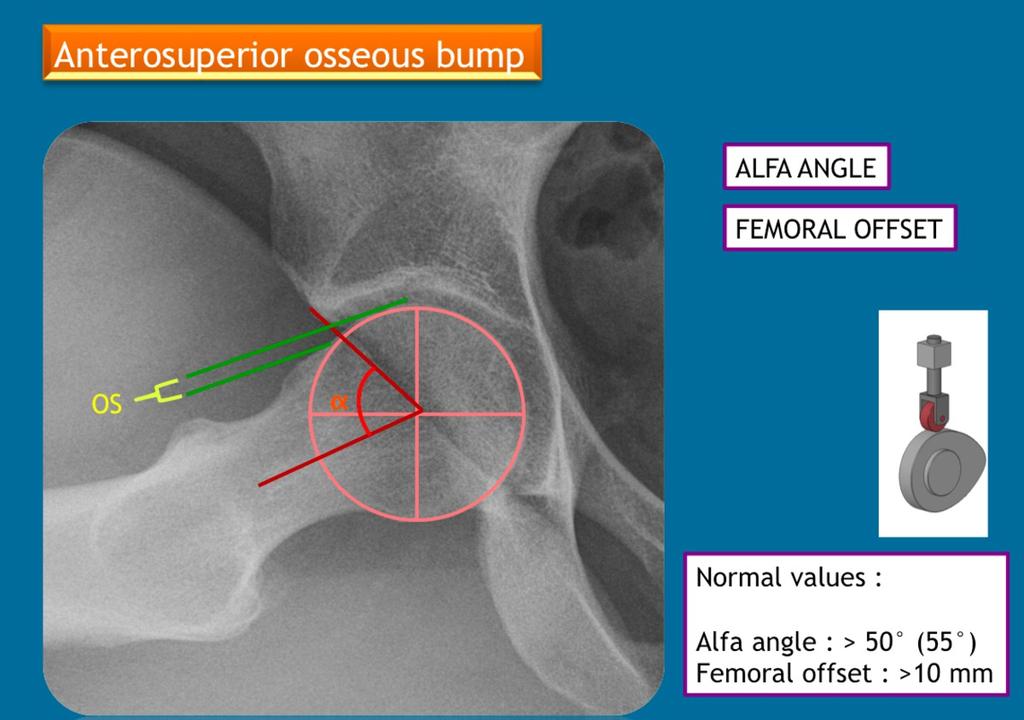 Fig. 16: Dunn view of a hip with anterosuperior osseous bump : Alfa angle is the angle between the femoral neck axis and a line connecting the head center with the point of beginning