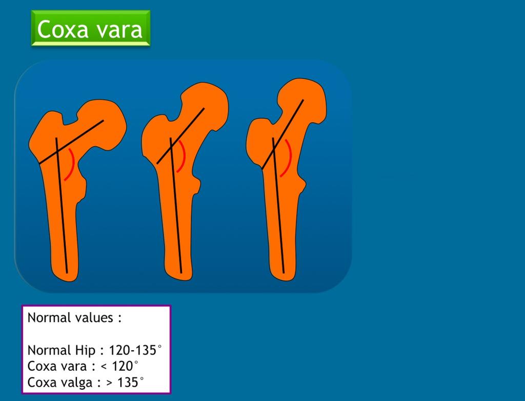 Fig. 17: Schematic drawing of coxa vara and valga, with