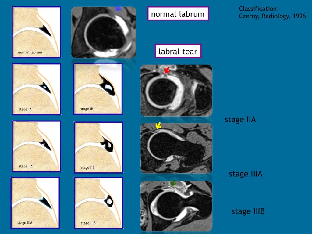 Fig. 20: Schematic overview of labral tears, according to the Czerny classification.