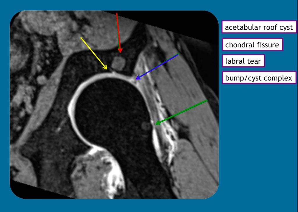 Fig. 21: Paracoronal reconstruction of a transverse oblique 3D GRE shows an acetabular roof cyst (red