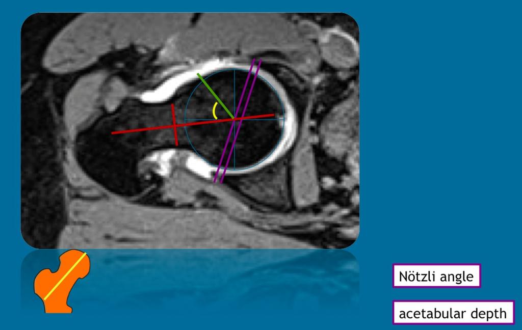 Fig. 24: The depth of the acetabulum is defined as the distance between a line connecting the anterior to the posterior acetabular rim and a parallel line through the femoral center (purple