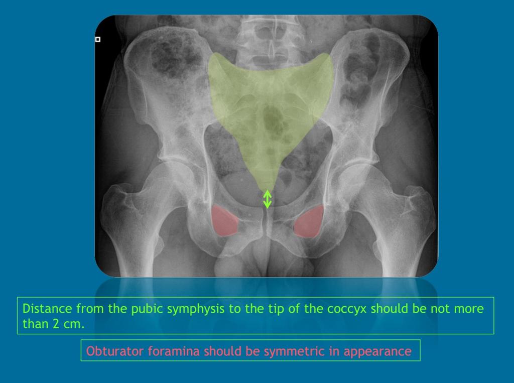 Fig. 2: AP pelvis : Ideally, the distance from pubic symphysis to the tip of the coccyx should be not more