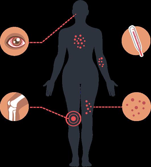 Zika 101 Primarily mosquito-borne transmission Other transmission routes: sexual, maternal-child, laboratory/healthcare exposure, blood transfusion 80% infections are asymptomatic Symptoms: fever,