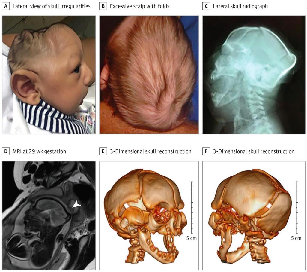 Cranial morphology in Congenital Zika Syndrome Moore CA et