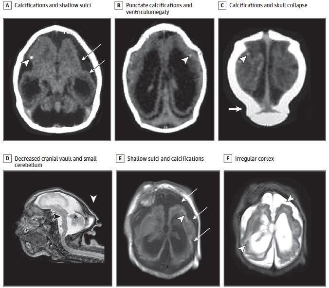 Brain findings in Congenital Zika Syndrome Moore CA et al.