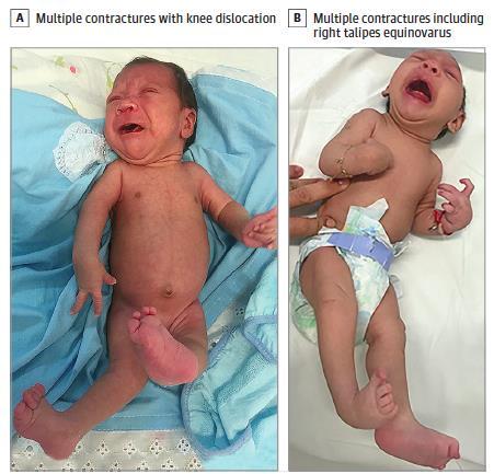 Microcephaly and arthrogryphosis in CZS Moore CA et al.