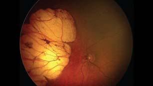 Hemorrhagic retinopathy Abnormal