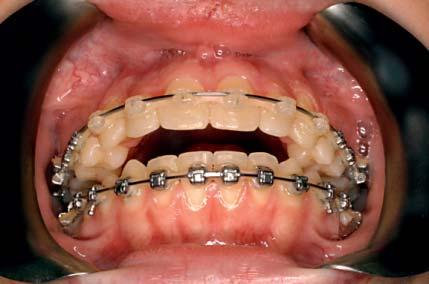 She was treated orthodontically for a Class I malocclusion with a good outcome a few years earlier. However, after treatment, her bite began to change with development of an anterior open bite.