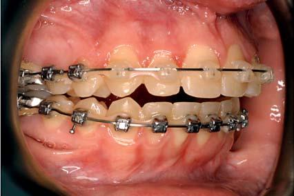 The bite stabilized over the past year so it was felt that orthognathic surgery would be safe to perform. She underwent a very short orthodontic treatment to prepare her teeth for surgery.