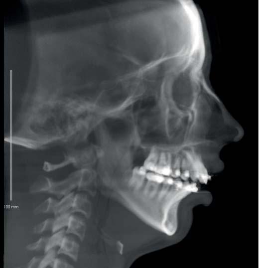 Treatment Plan Radiographic evaluation indicated that her anterior open bite was likely secondary to symmetric bilateral condylar degeneration.