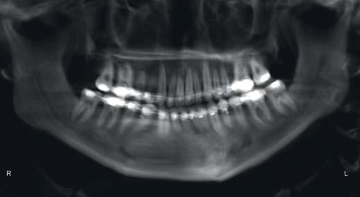 Her treatment plan was for a three-piece maxillary osteotomy with anterior intrusion to decrease the tooth show and level the maxillary occlusal plane. This would increase the anterior open bite.