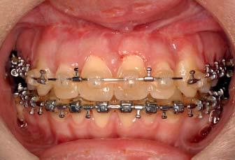 The maxillary splint was removed at seven weeks and the