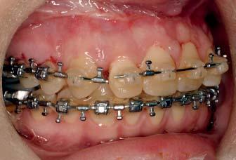 Patient continues to undergo postsurgical orthodontic