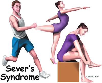 Introduction Sever s syndrome is a painful heel condition that affects growing adolescents between the ages of nine and 14.