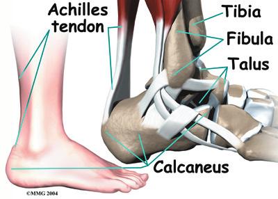 This tightens up the tendon and creates tension where it attaches to the heel. Eventually, the tension causes the area to become inflamed and painful.