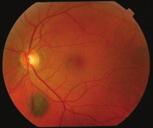 Level of the lesion The lesion and any associated features such as haemorrhage may be choroidal, sub-retinal, intra-retinal or pre-retinal.