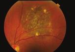Colour Choroidal naevi generally appear slate grey or brown. Melanocytomas are black. Congenital hypertrophy of the retinal epithelium is brown or black.