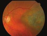 cent of naevi become symptomatic. 10 Symptoms may be caused by serous retinal detachment, photoreceptor atrophy or choroidal neovascularisation (Figure 8).