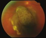 Figure 11 Choroidal melanoma collar stud Figure 12 Choroidal melanoma with inferior exudative retinal detachment the country; however, the patient will usually see a general ophthalmologist who will