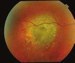 Diagnosis of malignant melanoma will be confirmed by the ocular oncologist following thorough history and examination.