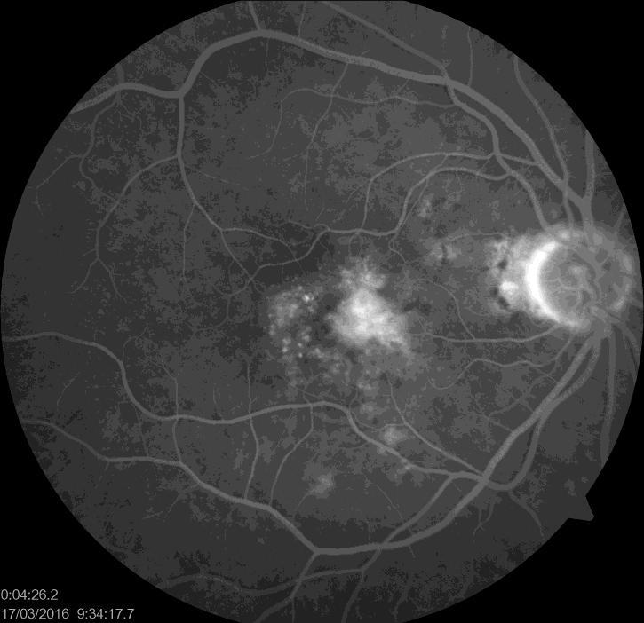 Figure 3. Conventional structural OCT: sub- and intraretinal fluid.