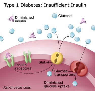 Diabetes Type 1 Diabetes mellitus (T1DM) Autoimmune disease where immune system destroyes beta cells => can not produce insulin when blood glc increases => no