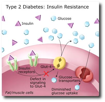 Diabetes Type 2 Diabetes mellitus (T2DM) Most common form of diabetes 1) Pancreas do not produce enough insulin (but not by the attack of immune cells) 2) cells of the
