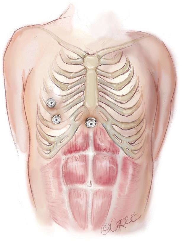 However, in non thymomatous myasthenia gravis or in more right-sided thymomas, we prefer to approach from the right hemithorax due to the increased space on this side (Figure 3).