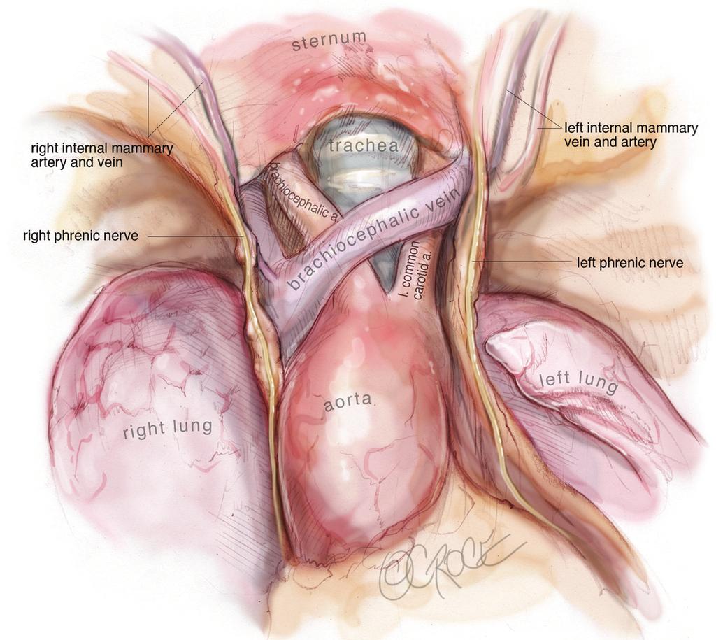 vein is followed across the midline. Figure 8 The final subxiphoid view after thymus removal. For complete thymectomy the space above the innominate should be clear of thymus and thymic fat.