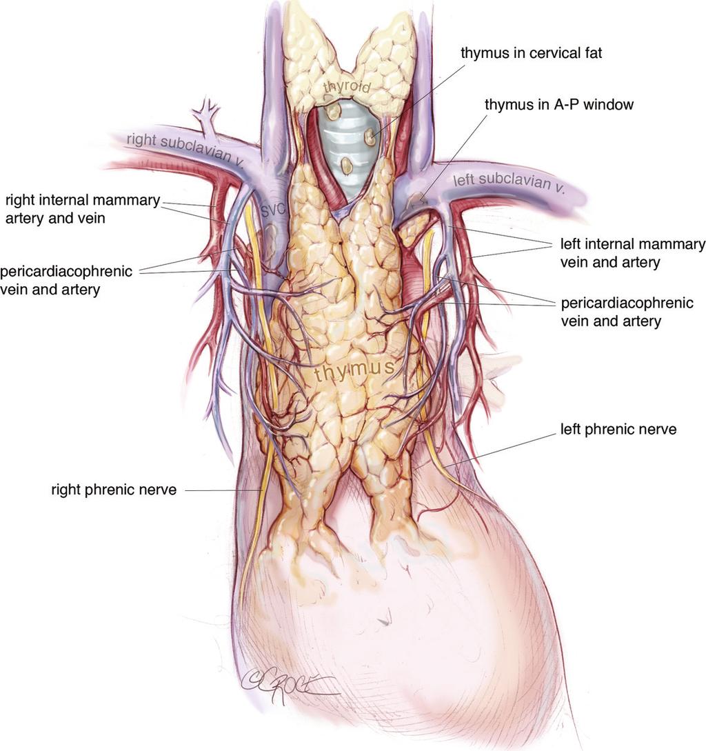 The phrenic nerves will demarcate the lateral borders of the resection. blocks are placed using a long needle under vision from the subxiphoid port.