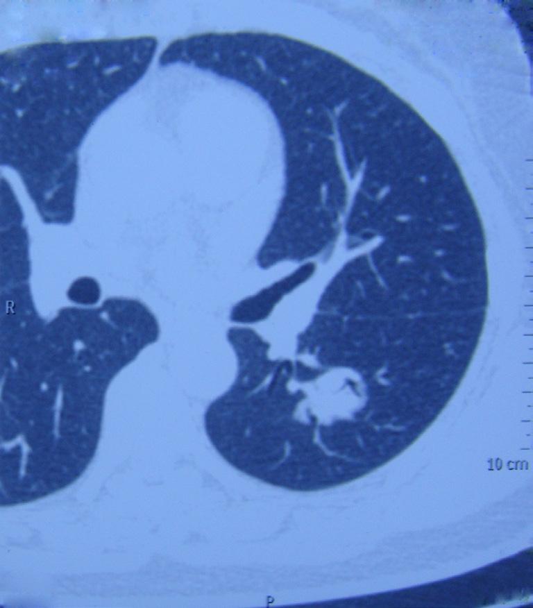 Figure 5 Dissociate the inferior pulmonary ligament.