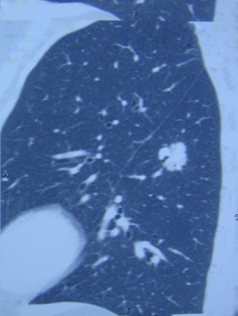 (Figures 9,10). (VIII) Remove several subcarinal lymph nodes (Figure 11).