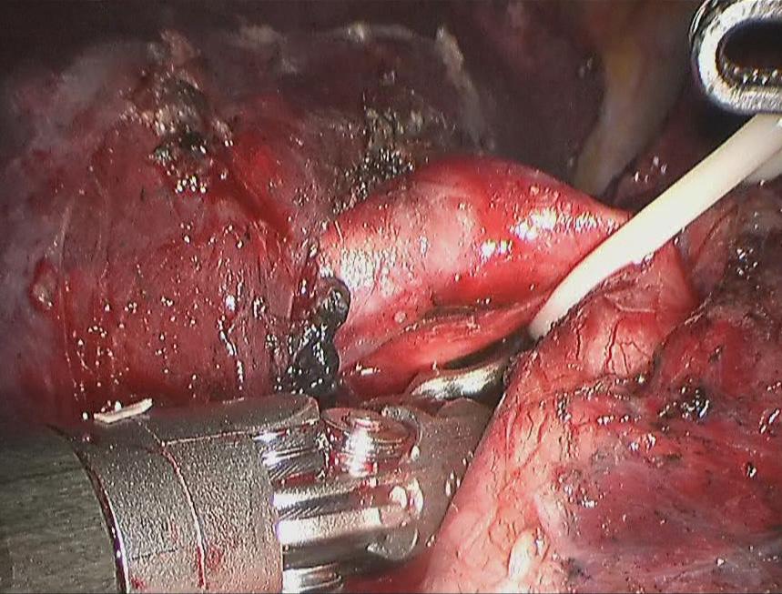 Basal segmental artery Figure 16 Transect the bronchus