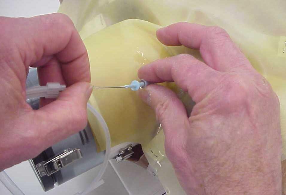 Insert the needle into the vein using ultrasound to guide the