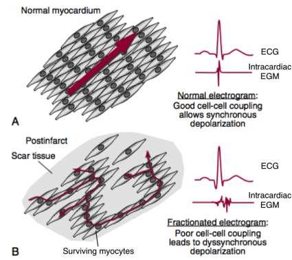 8 Figure 1-5 Effect of scar on electrical propagation.