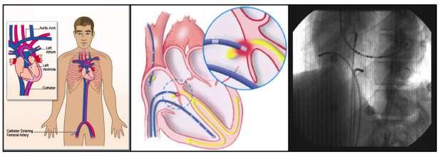 10 Figure 1-6 Electrophysiology (EP) is a subspecialty of cardiology and is the science of elucidating, diagnosing, and treating the electrical activities of the heart.