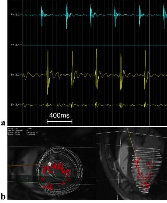 Figure 2-2 (a) Bipolar pacing stimulation from the right ventricle (RV) from catheter electrodes 1-2 pair and recording of the arrival time in the left ventricle (LV) with the mapping catheter LV 1-2