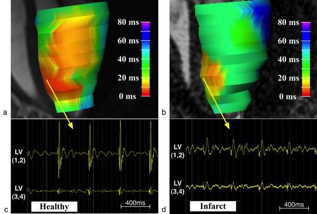 39 Figure 2-6 Isochronal LAT maps - comparison between a healthy heart (a) and an infarct heart (b).