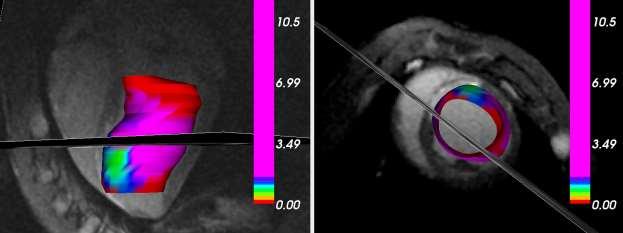 83 Figure 5-1 Three-dimensional bipolar voltage maps using the MRI-guided electrophysiology system in an animal with prior