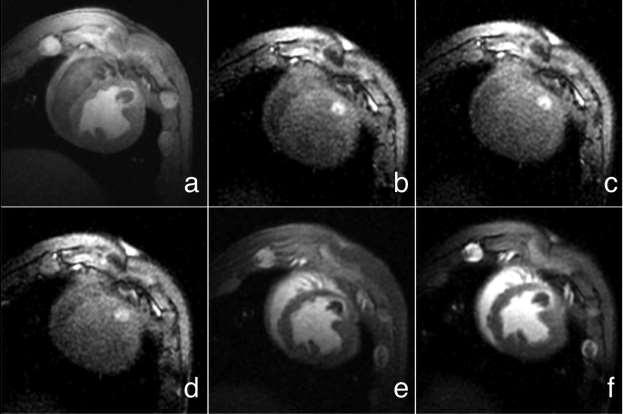 Combining the results from the lesion characterization studies in this chapter and the results from the studies in Chapter 4 will provide the necessary tools to validate the performance of MR- Guided