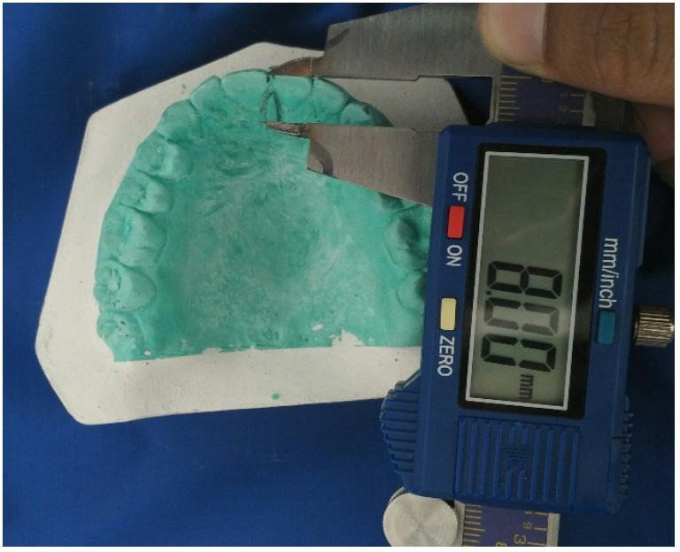 Figure 3. Measurement of distance from posterior point of incisive papilla to the mesio-incisal edge from labial side of maxillary central incisor Figure 4.